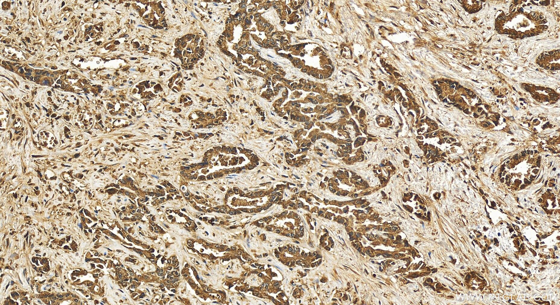 Immunohistochemistry (IHC) staining of human intrahepatic cholangiocarcinoma tissue using ARFGEF2 Polyclonal antibody (31277-1-AP)