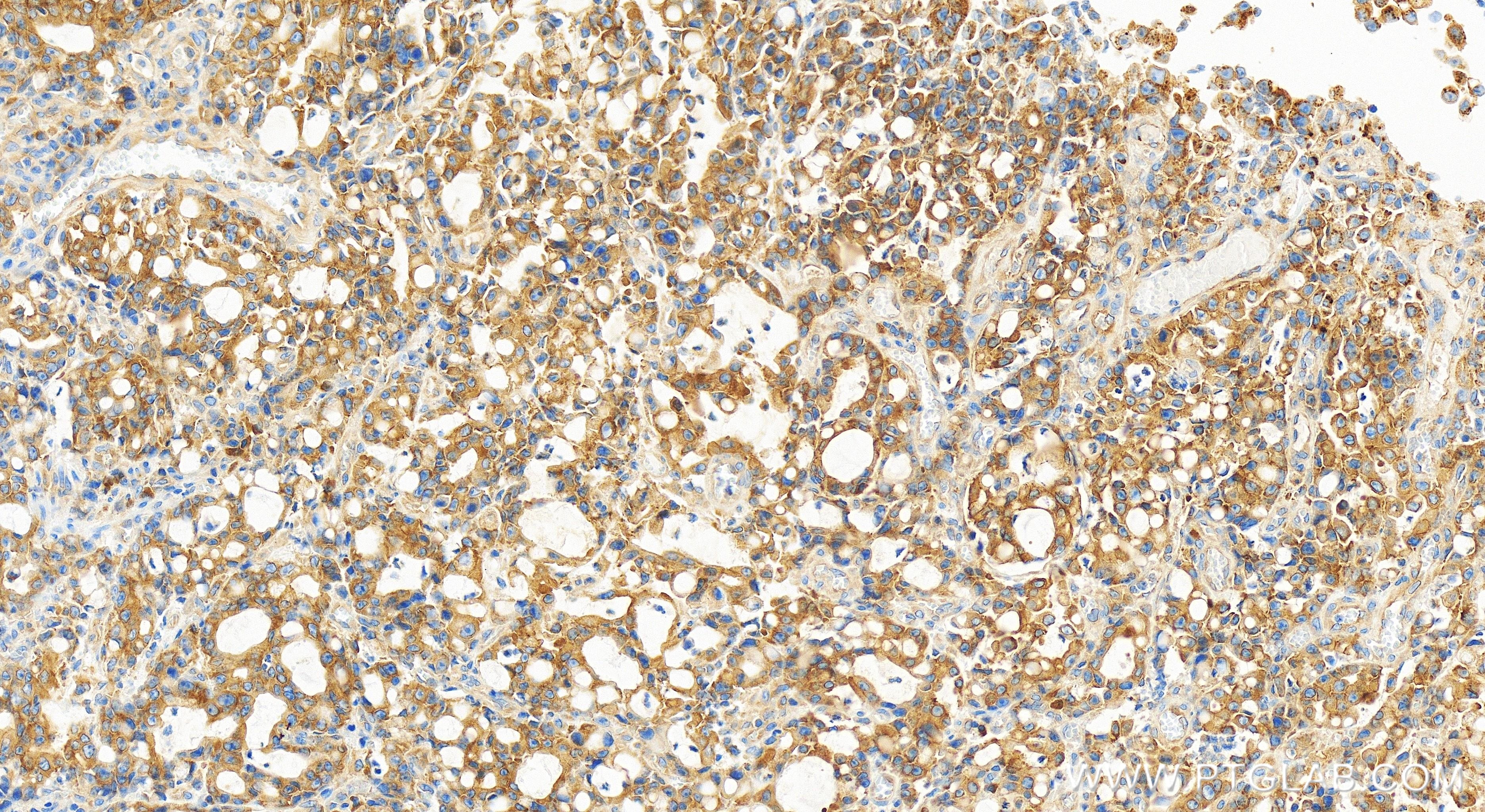 Immunohistochemistry (IHC) staining of human stomach cancer tissue using ARFGEF2 Recombinant antibody (84296-4-RR)