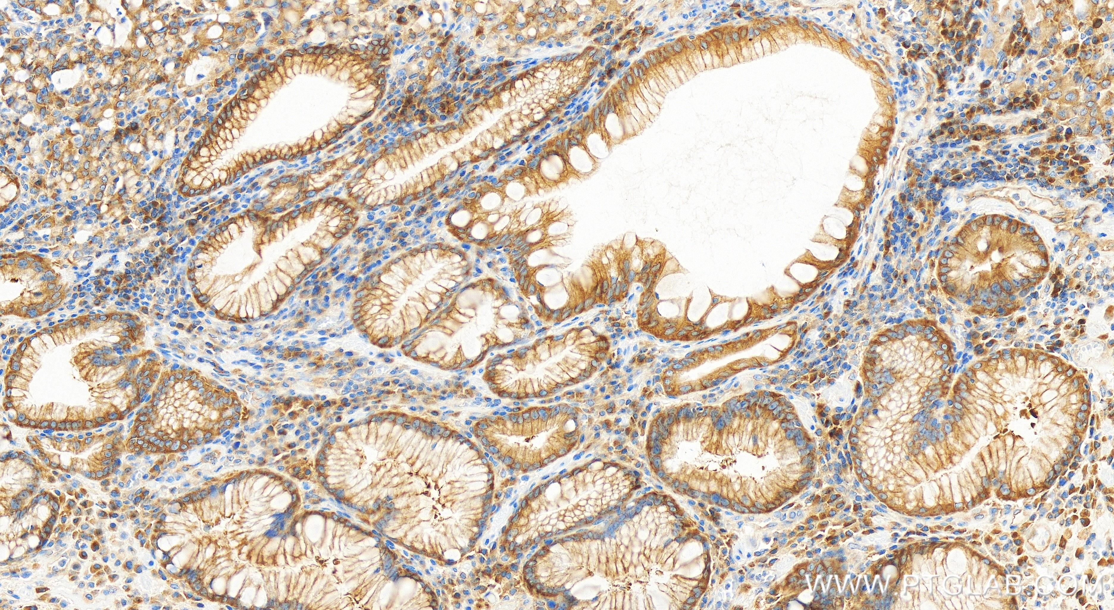 Immunohistochemistry (IHC) staining of human stomach cancer tissue using ARFGEF2 Recombinant antibody (84296-4-RR)