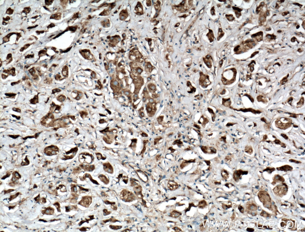 Immunohistochemistry (IHC) staining of human breast cancer tissue using Arfaptin-1 Polyclonal antibody (17726-1-AP)