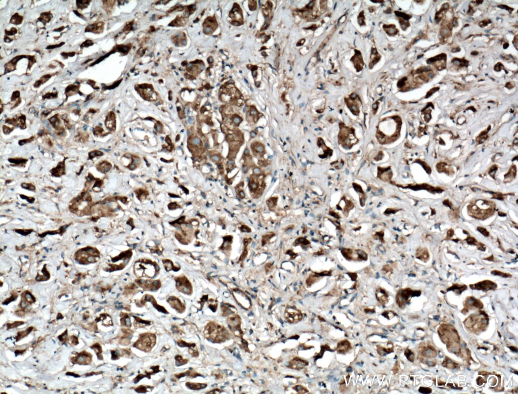 IHC staining of human breast cancer using 17726-1-AP