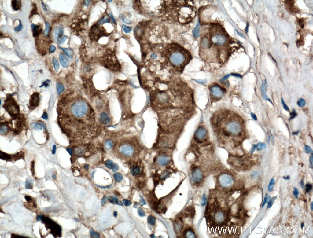 Immunohistochemistry (IHC) staining of human breast cancer tissue using Arfaptin-1 Polyclonal antibody (17726-1-AP)