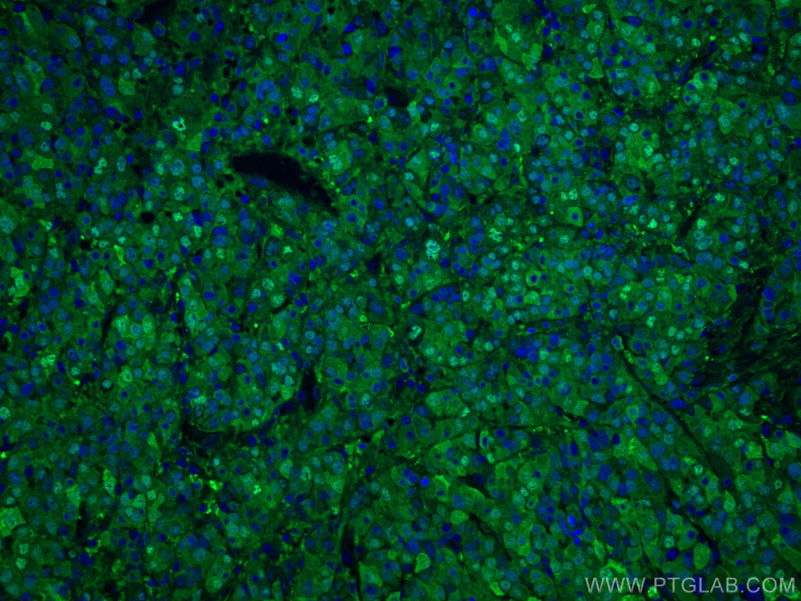Immunofluorescence (IF) / fluorescent staining of human liver cancer tissue using Arginase-1 Polyclonal antibody (16001-1-AP)