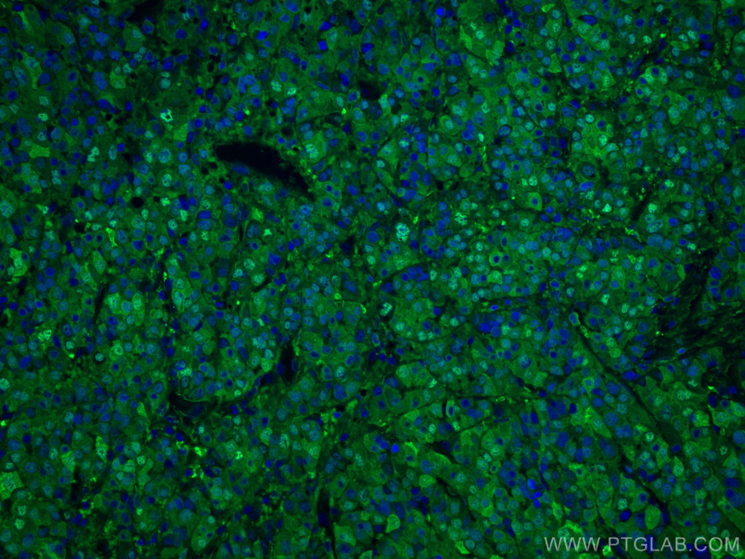 IF Staining of human liver cancer using 16001-1-AP