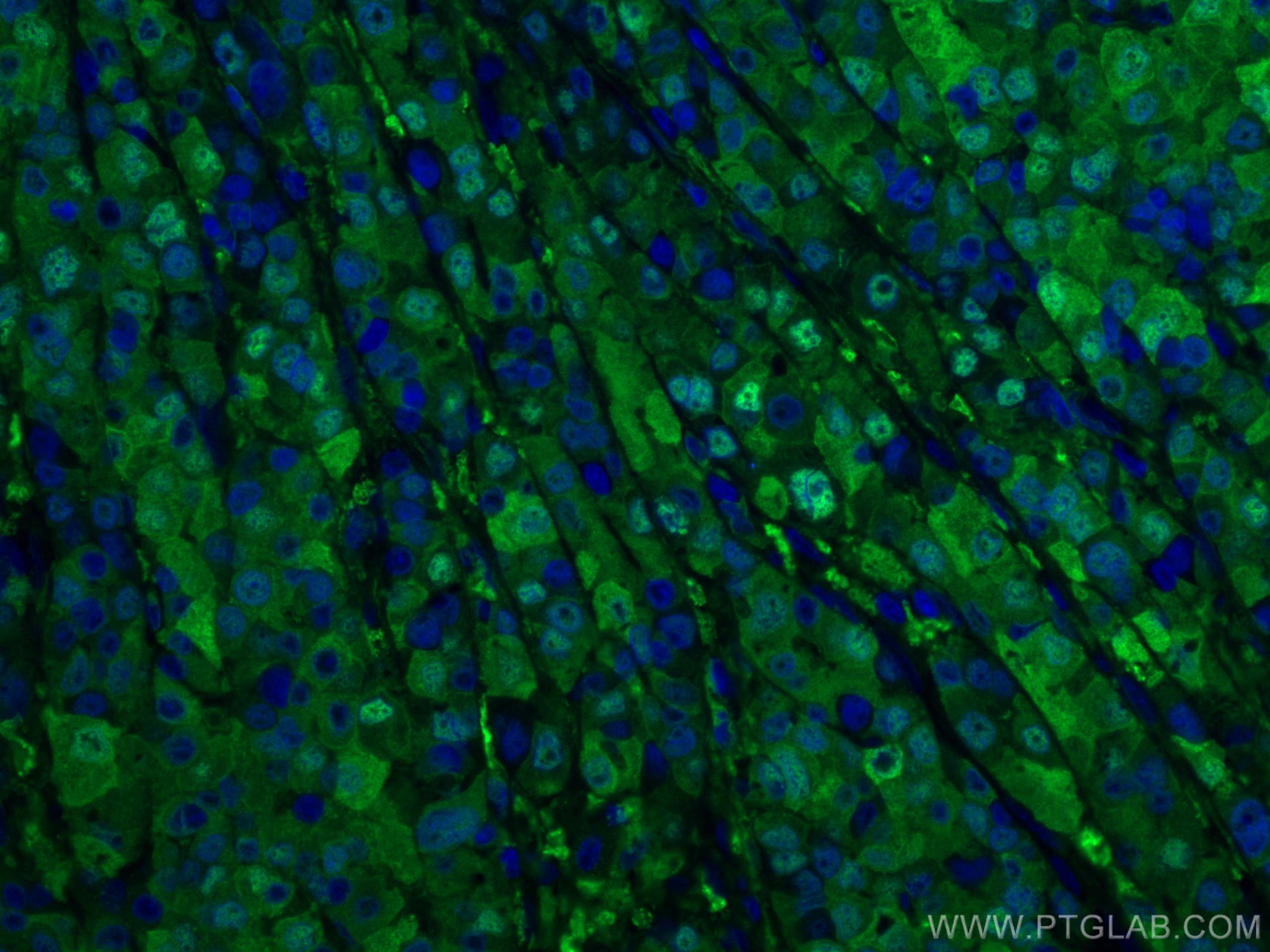 Immunofluorescence (IF) / fluorescent staining of human liver cancer tissue using Arginase-1 Polyclonal antibody (16001-1-AP)