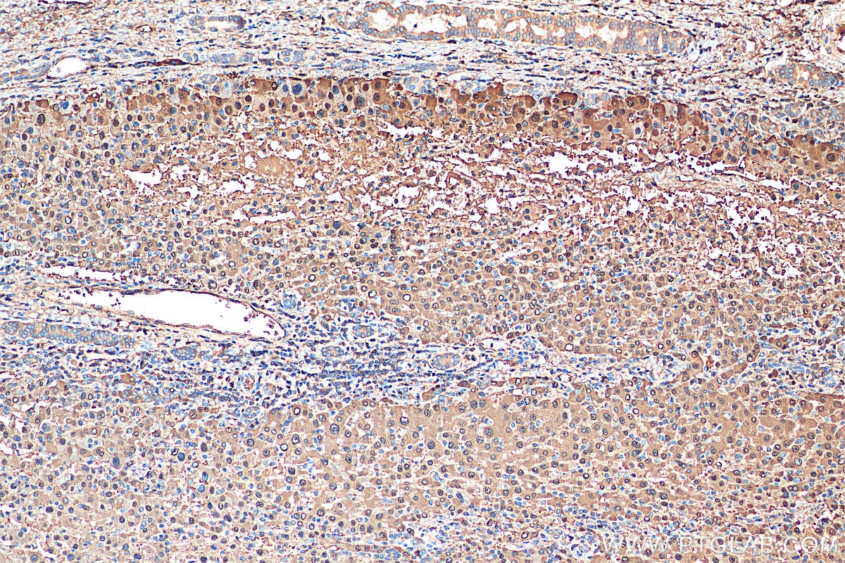 Immunohistochemistry (IHC) staining of human liver cancer tissue using Arginase-1 Polyclonal antibody (16001-1-AP)