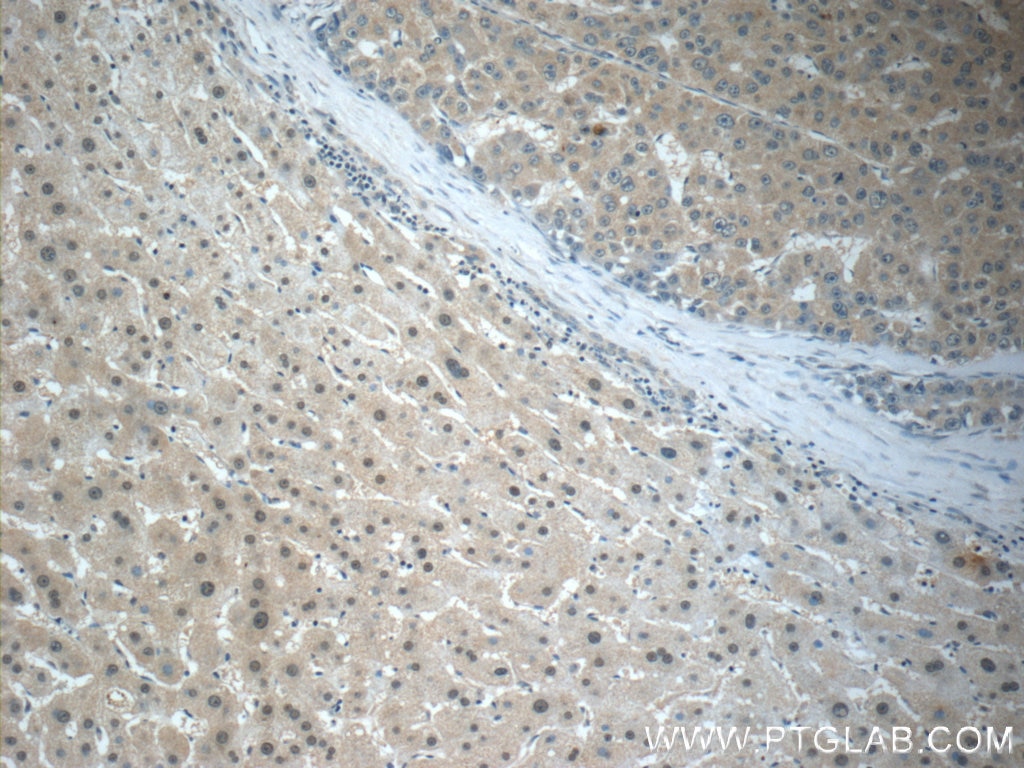 Immunohistochemistry (IHC) staining of human liver cancer tissue using Arginase-1 Monoclonal antibody (66129-1-Ig)