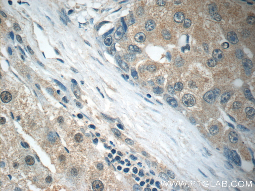 Immunohistochemistry (IHC) staining of human liver cancer tissue using Arginase-1 Monoclonal antibody (66129-1-Ig)