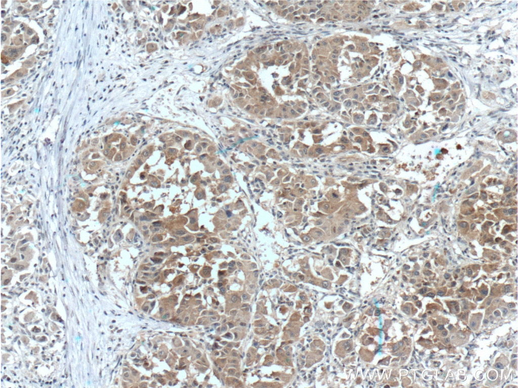 Immunohistochemistry (IHC) staining of human liver cancer tissue using Arginase-1 Monoclonal antibody (66129-1-Ig)