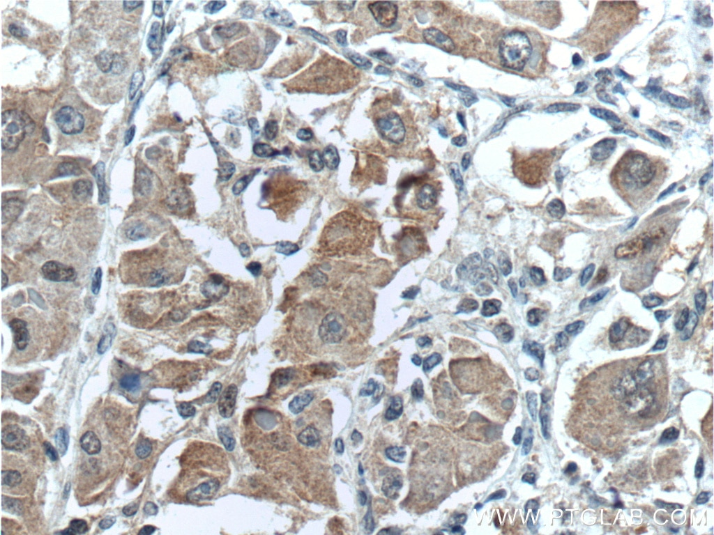 Immunohistochemistry (IHC) staining of human liver cancer tissue using Arginase-1 Monoclonal antibody (66129-1-Ig)