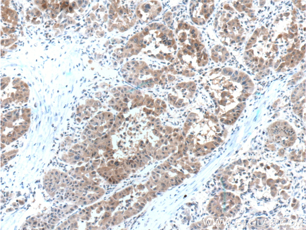 Immunohistochemistry (IHC) staining of human liver cancer tissue using Arginase-1 Monoclonal antibody (66129-1-Ig)