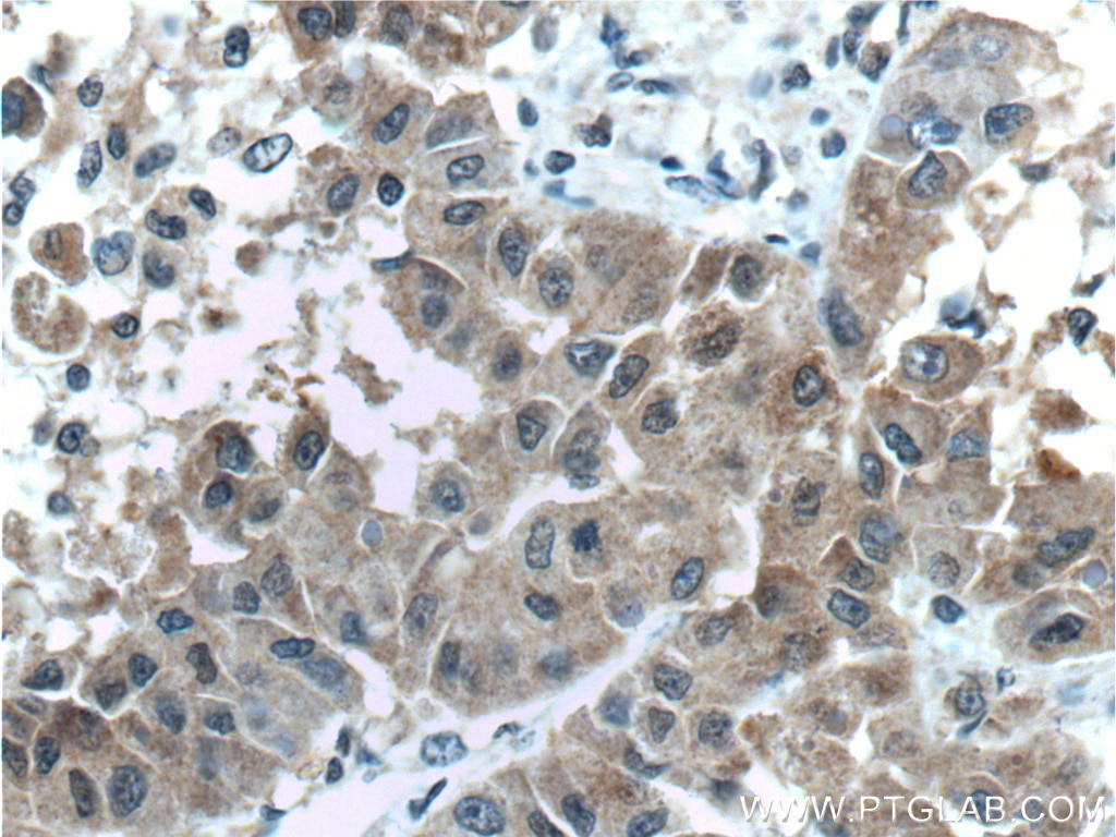 Immunohistochemistry (IHC) staining of human liver cancer tissue using Arginase-1 Monoclonal antibody (66129-1-Ig)