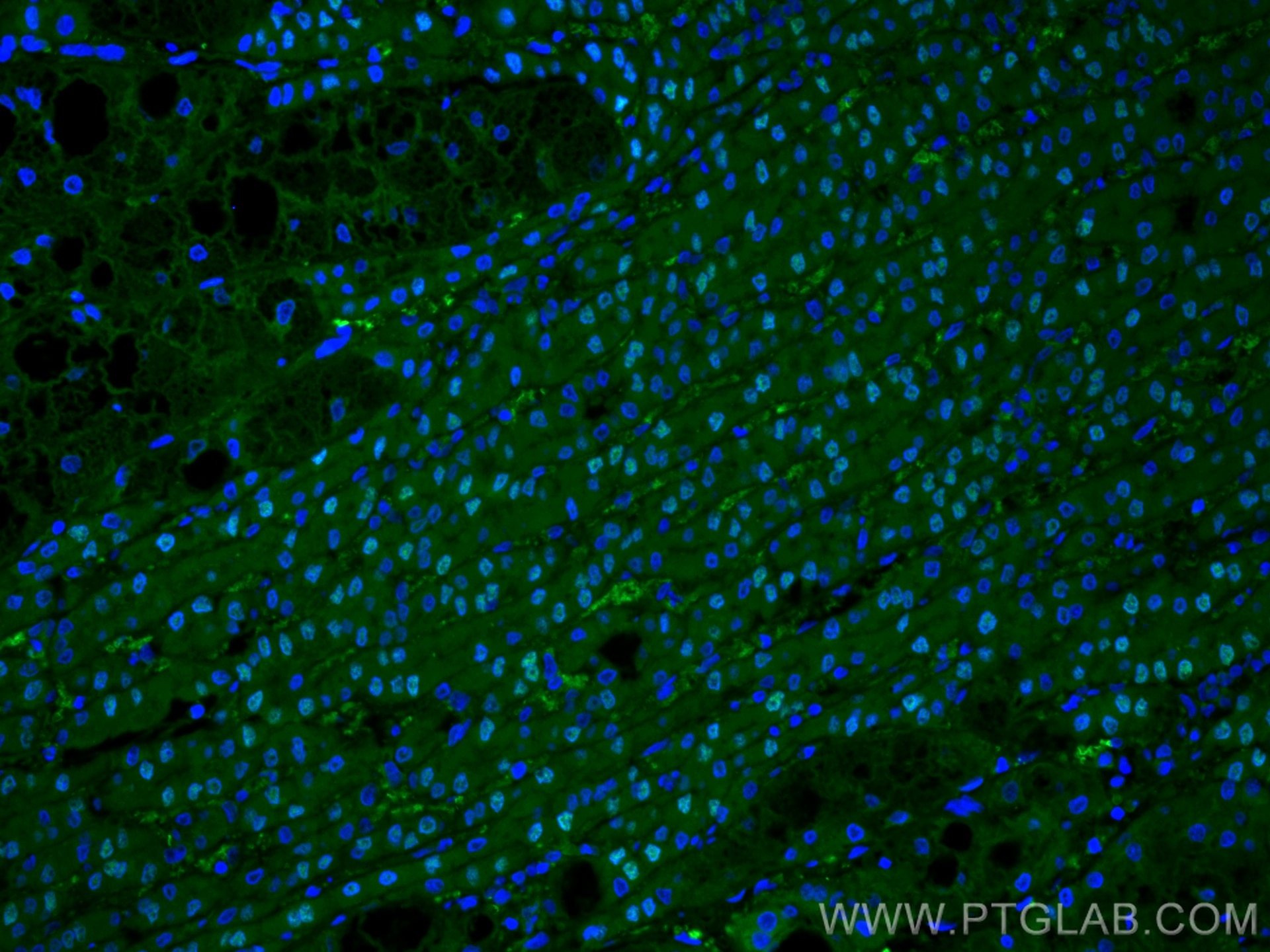 Immunofluorescence (IF) / fluorescent staining of human liver cancer tissue using CoraLite® Plus 488-conjugated ARG1 Polyclonal anti (CL488-16001)