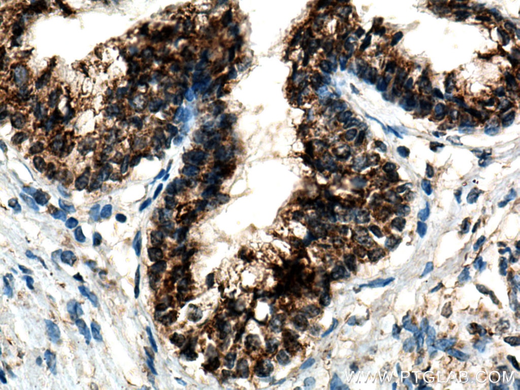 Immunohistochemistry (IHC) staining of human prostate cancer tissue using ARG2 Polyclonal antibody (14825-1-AP)
