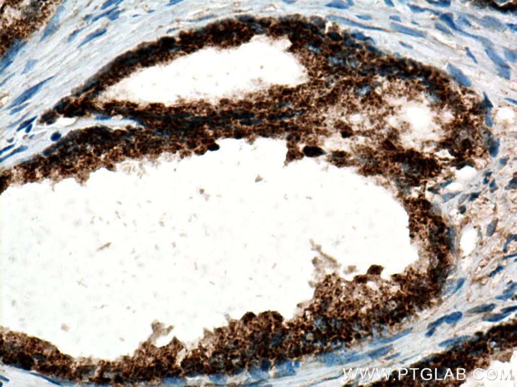 Immunohistochemistry (IHC) staining of human prostate cancer tissue using ARG2 Polyclonal antibody (14825-1-AP)