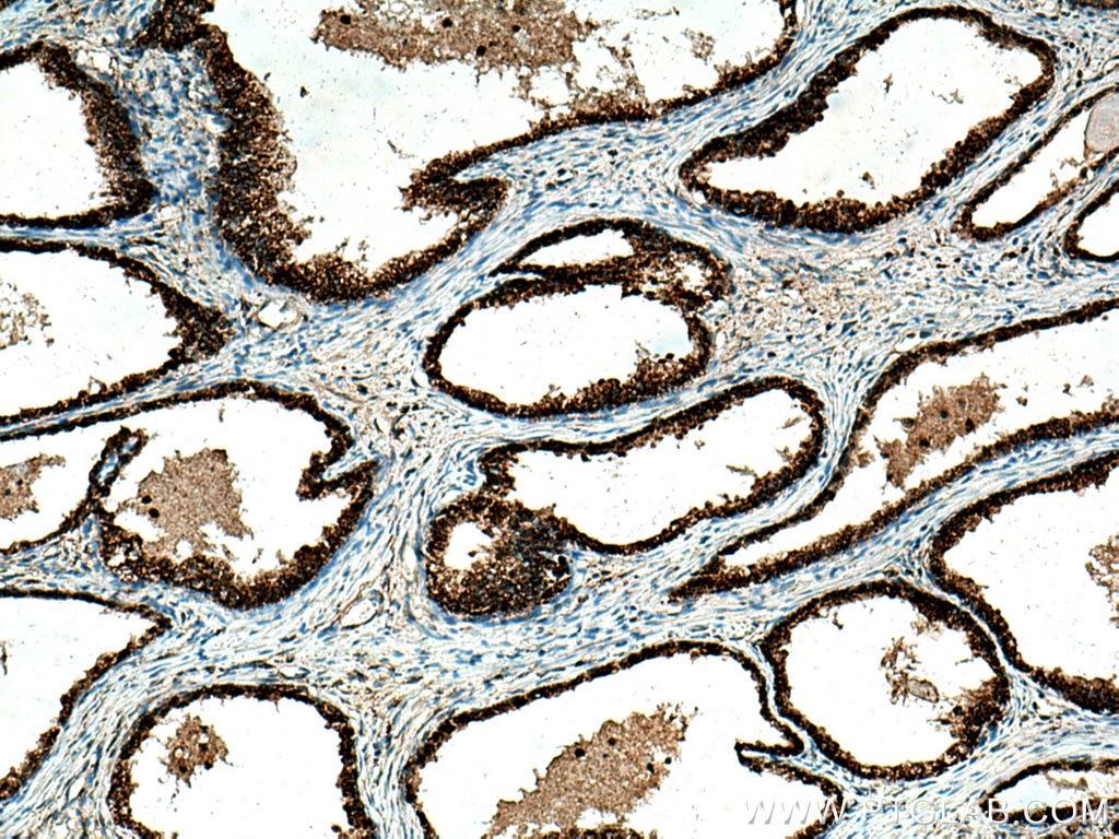 Immunohistochemistry (IHC) staining of human prostate cancer tissue using ARG2 Polyclonal antibody (14825-1-AP)