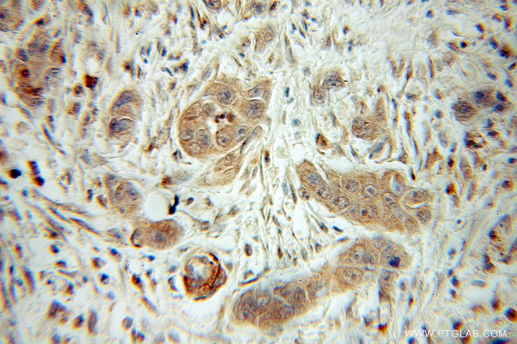 Immunohistochemistry (IHC) staining of human pancreas cancer tissue using ARHGAP1 Polyclonal antibody (11169-1-AP)