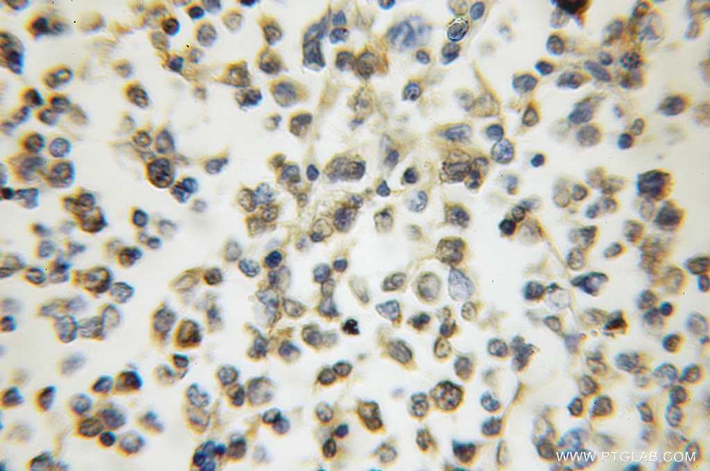 IHC staining of human lymphoma using 11940-1-AP