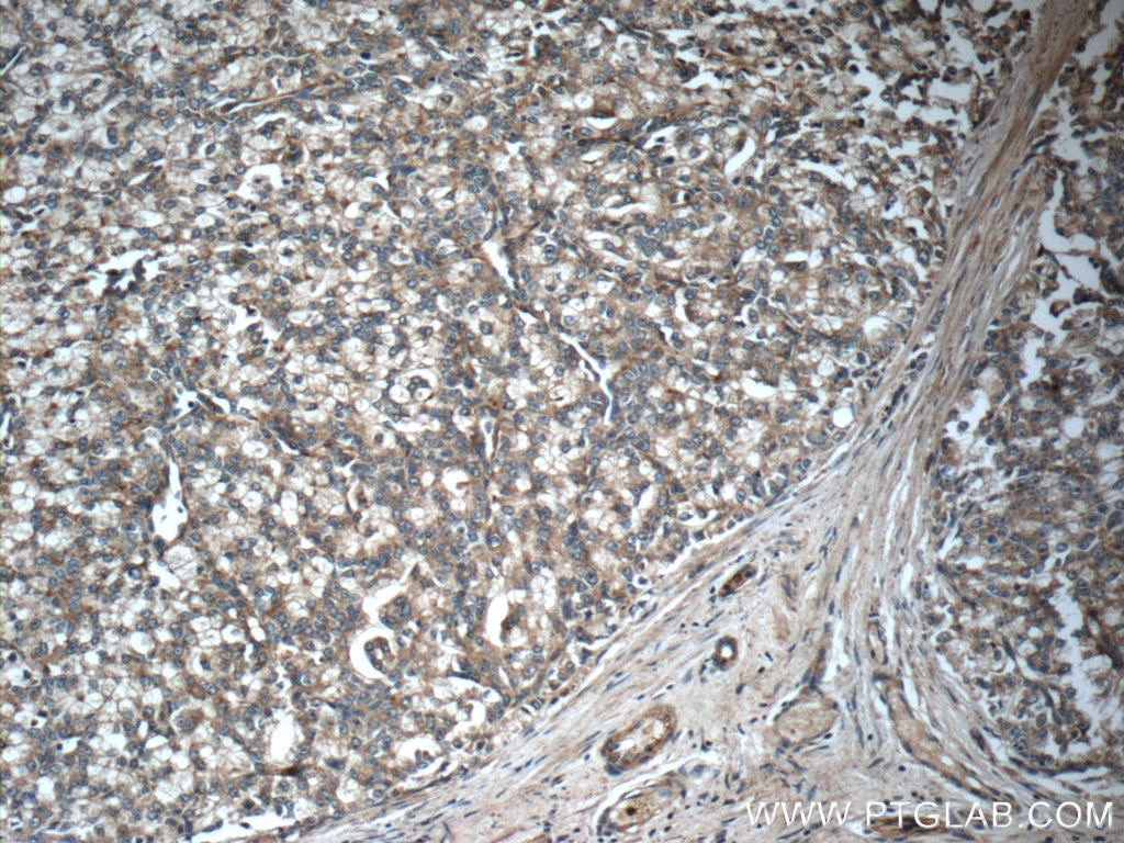 Immunohistochemistry (IHC) staining of human prostate cancer tissue using ARHGAP21 Polyclonal antibody (22183-1-AP)