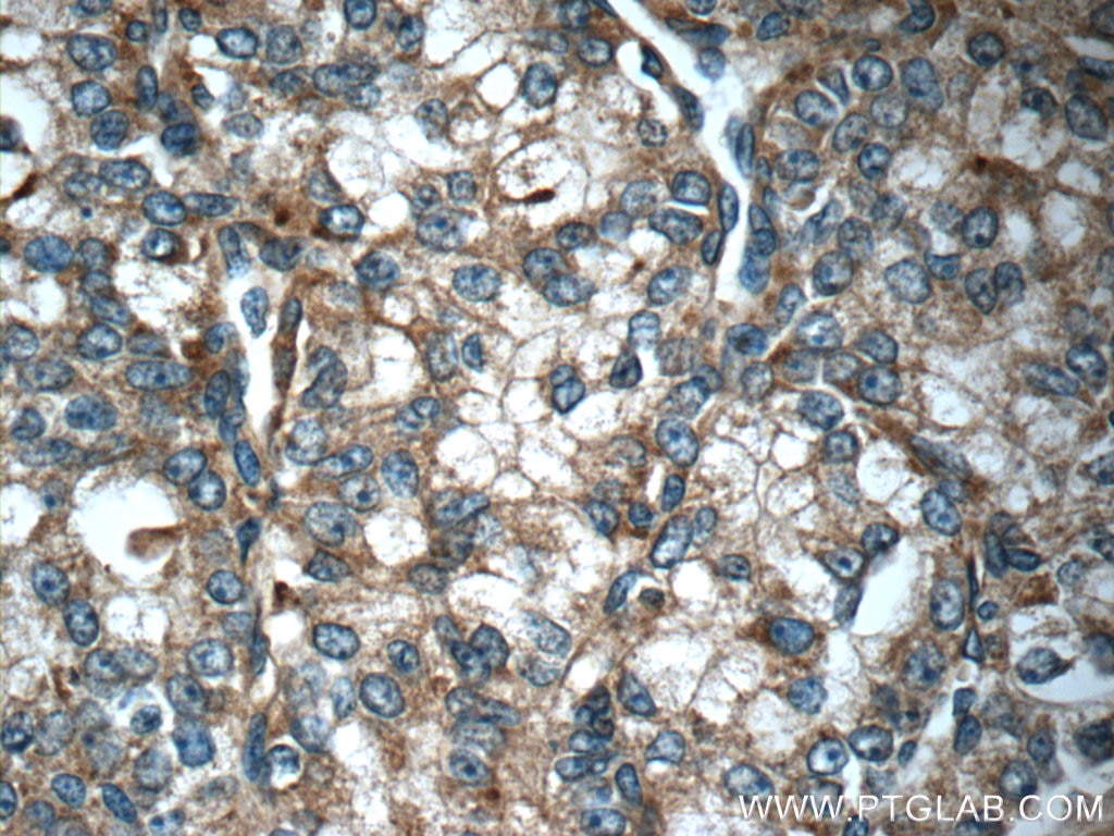 Immunohistochemistry (IHC) staining of human prostate cancer tissue using ARHGAP21 Polyclonal antibody (22183-1-AP)