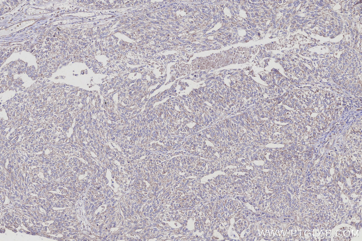 IHC staining of human ovary cancer using 31938-1-AP Immunohistochemistry (IHC) staining of human ovary cancer tissue using ARHGAP23 Polyclonal antibody (31938-1-AP)