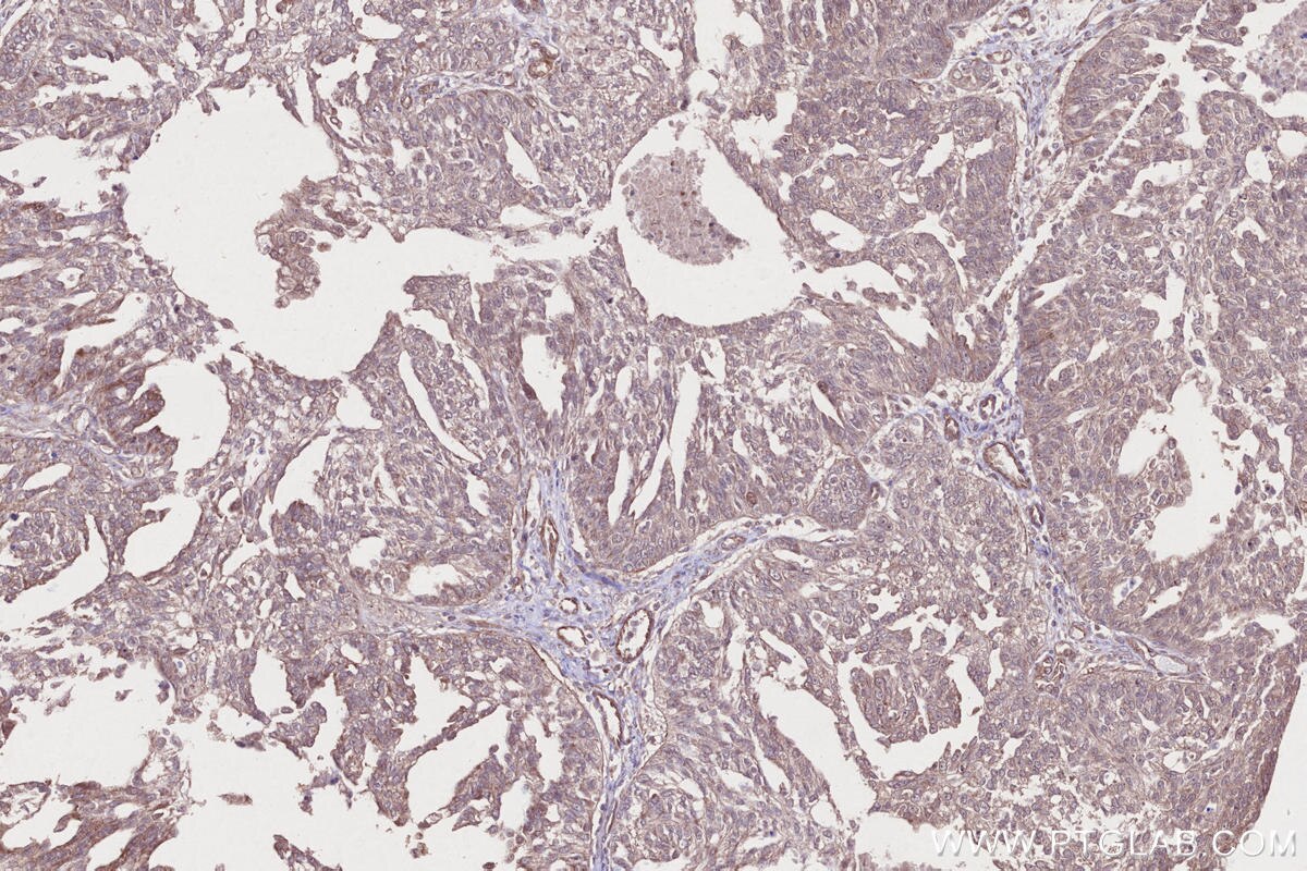 IHC staining of human ovary cancer using 18834-1-AP Immunohistochemistry (IHC) staining of human ovary cancer tissue using ARHGAP24 Polyclonal antibody (18834-1-AP)