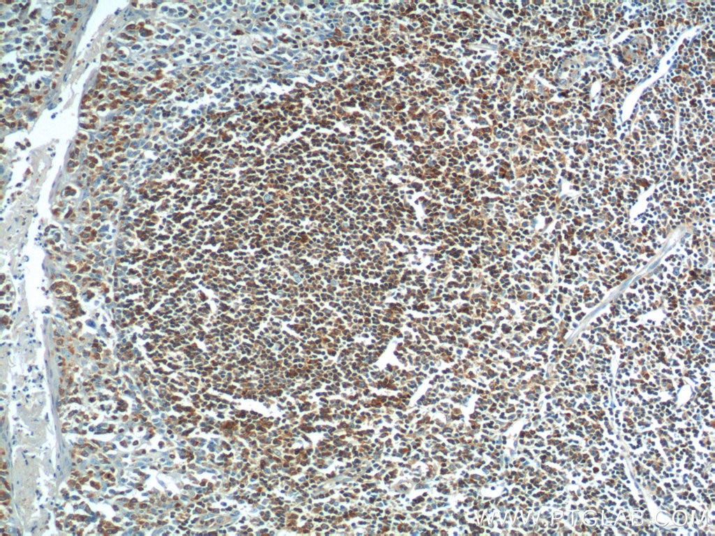 Immunohistochemistry (IHC) staining of human tonsillitis tissue using ARHGAP25 Polyclonal antibody (14349-1-AP)