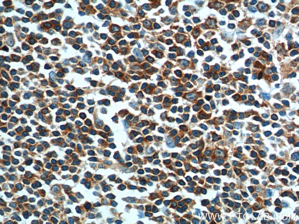 IHC staining of human tonsillitis using 14349-1-AP