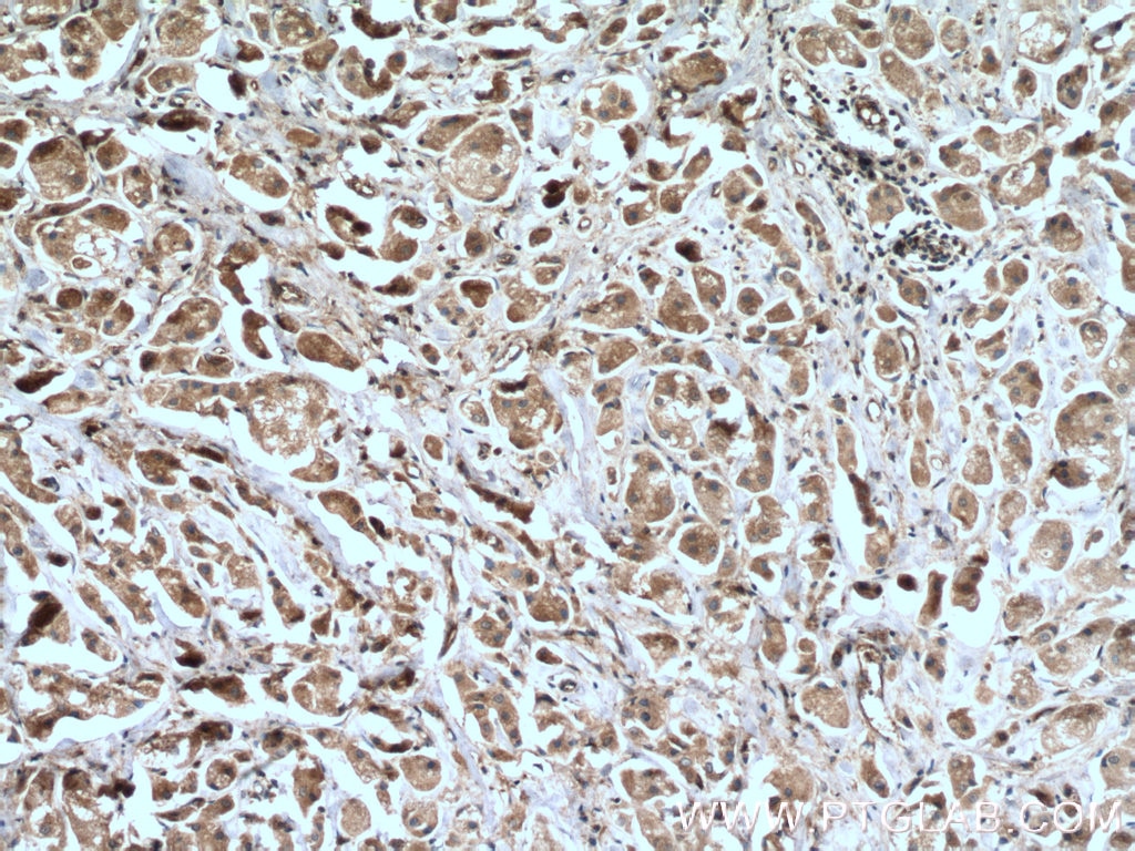 Immunohistochemistry (IHC) staining of human breast cancer tissue using ARHGAP27 Polyclonal antibody (22077-1-AP)