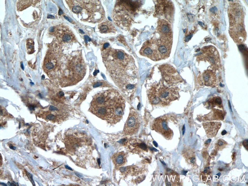 Immunohistochemistry (IHC) staining of human breast cancer tissue using ARHGAP27 Polyclonal antibody (22077-1-AP)