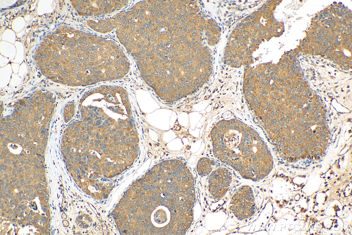 Immunohistochemistry (IHC) staining of human breast cancer tissue using ARHGAP29 Polyclonal antibody (12583-1-AP)
