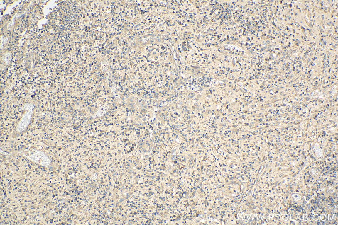 Immunohistochemistry (IHC) staining of human colon cancer tissue using ARHGAP29 Polyclonal antibody (12583-1-AP)