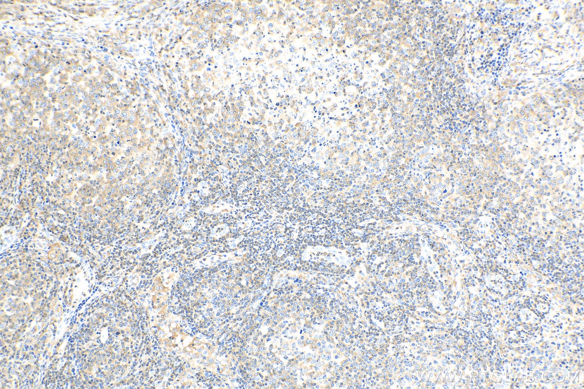 Immunohistochemistry (IHC) staining of human lymphoma tissue using ARHGAP4 Polyclonal antibody (16697-1-AP)