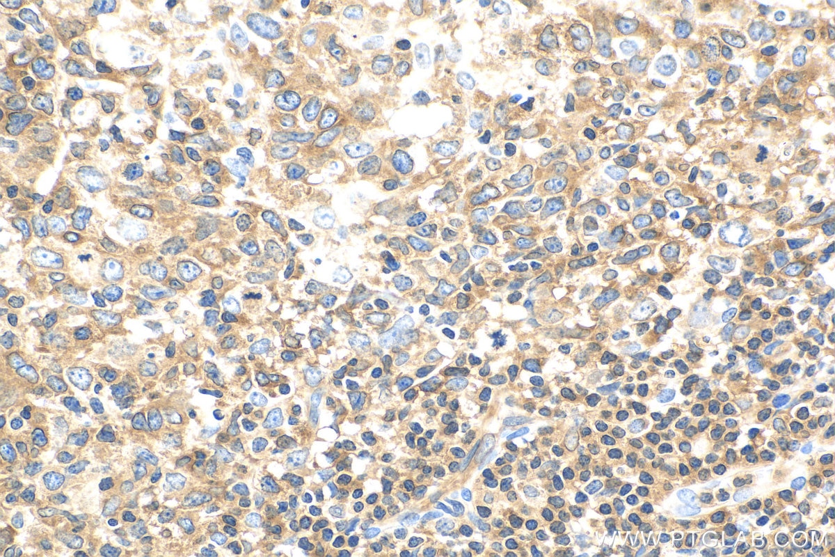 Immunohistochemistry (IHC) staining of human lymphoma tissue using ARHGAP4 Polyclonal antibody (16697-1-AP)