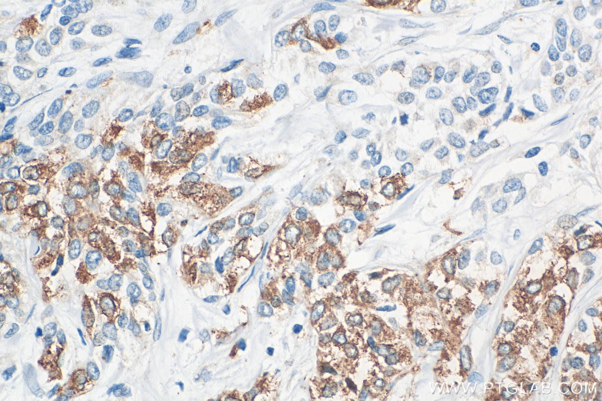 Immunohistochemistry (IHC) staining of human urothelial carcinoma tissue using ARHGAP44 Polyclonal antibody (32382-1-AP)