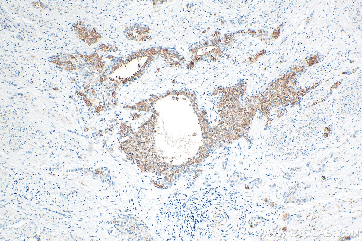 Immunohistochemistry (IHC) staining of human urothelial carcinoma tissue using ARHGAP44 Polyclonal antibody (32382-1-AP)