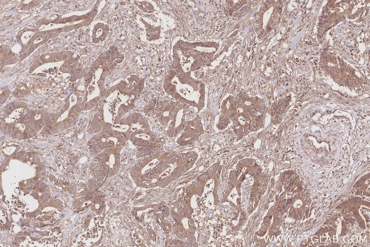 Immunohistochemistry (IHC) staining of human rectal cancer tissue using ARHGAP9 Polyclonal antibody (15665-1-AP)