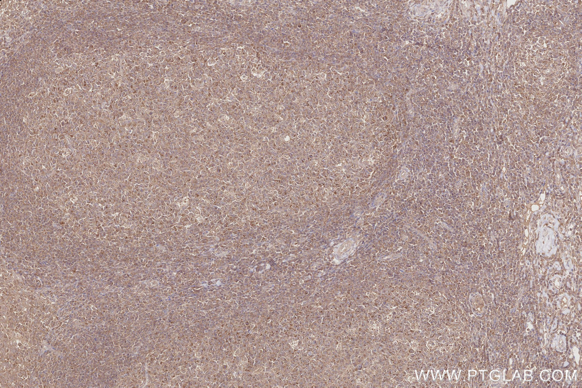 Immunohistochemistry (IHC) staining of human tonsillitis tissue using ARHGAP9 Polyclonal antibody (15665-1-AP)