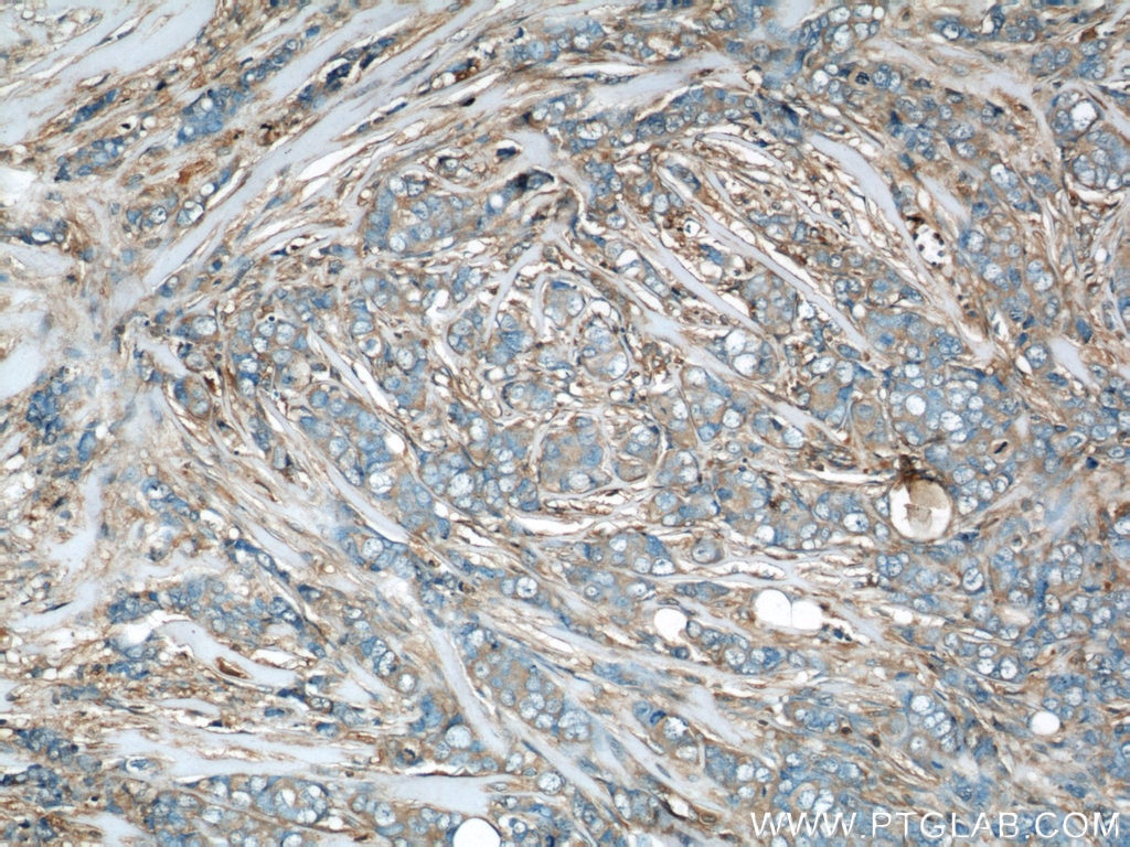 Immunohistochemistry (IHC) staining of human breast cancer tissue using RhoGDI Polyclonal antibody (10509-1-Ig)