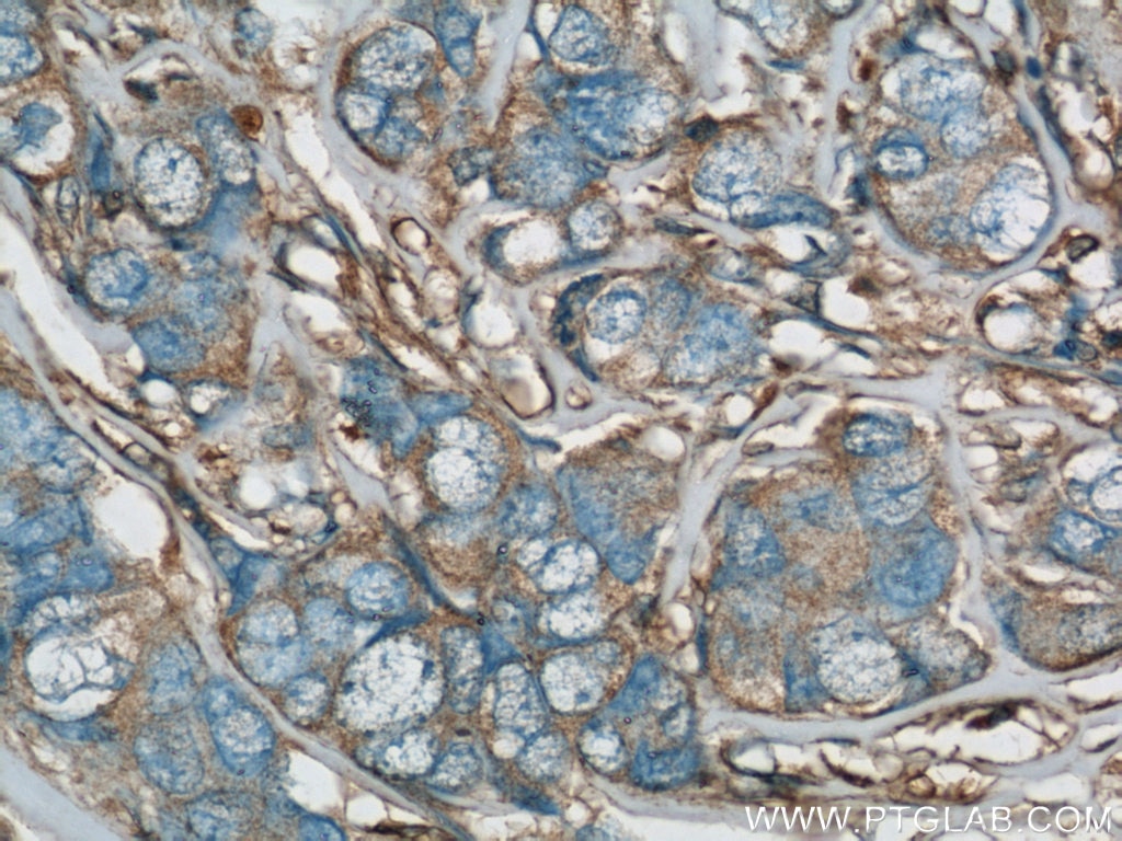 Immunohistochemistry (IHC) staining of human breast cancer tissue using RhoGDI Polyclonal antibody (10509-1-Ig)