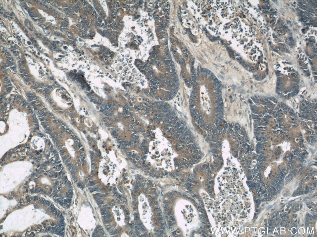 Immunohistochemistry (IHC) staining of human colon cancer tissue using RhoGDI Polyclonal antibody (10509-1-Ig)