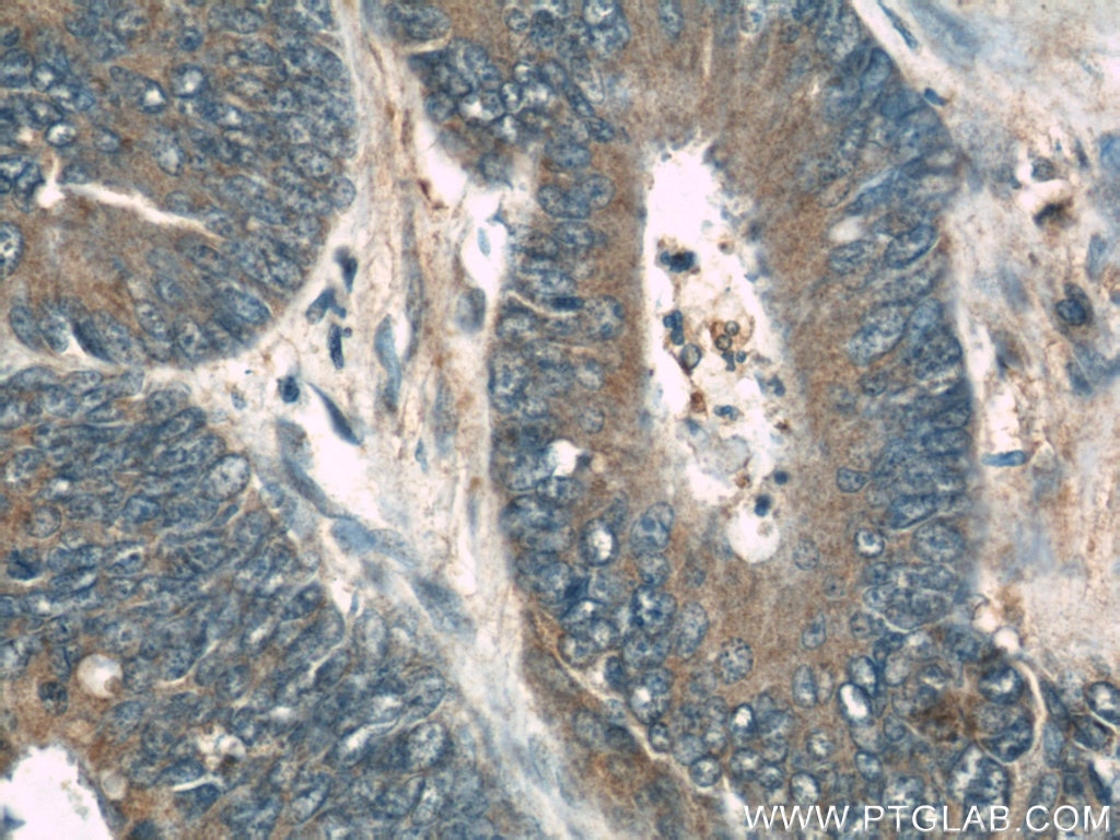 Immunohistochemistry (IHC) staining of human colon cancer tissue using RhoGDI Polyclonal antibody (10509-1-Ig)