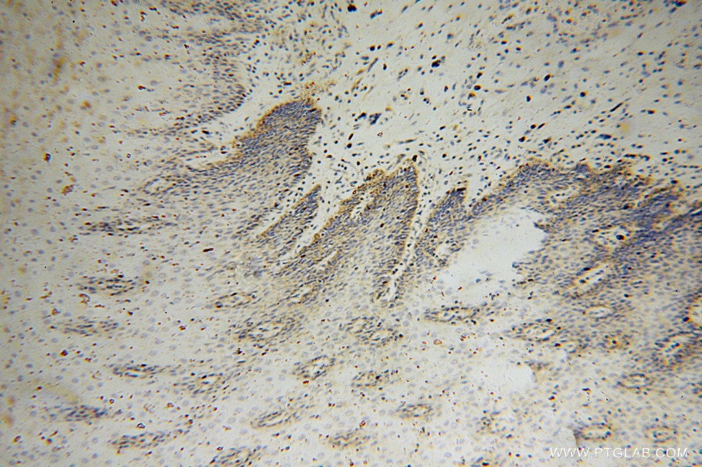 Immunohistochemistry (IHC) staining of human stomach cancer tissue using ARHGDIB Polyclonal antibody (16122-1-AP)