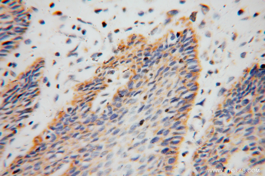 Immunohistochemistry (IHC) staining of human stomach cancer tissue using ARHGDIB Polyclonal antibody (16122-1-AP)