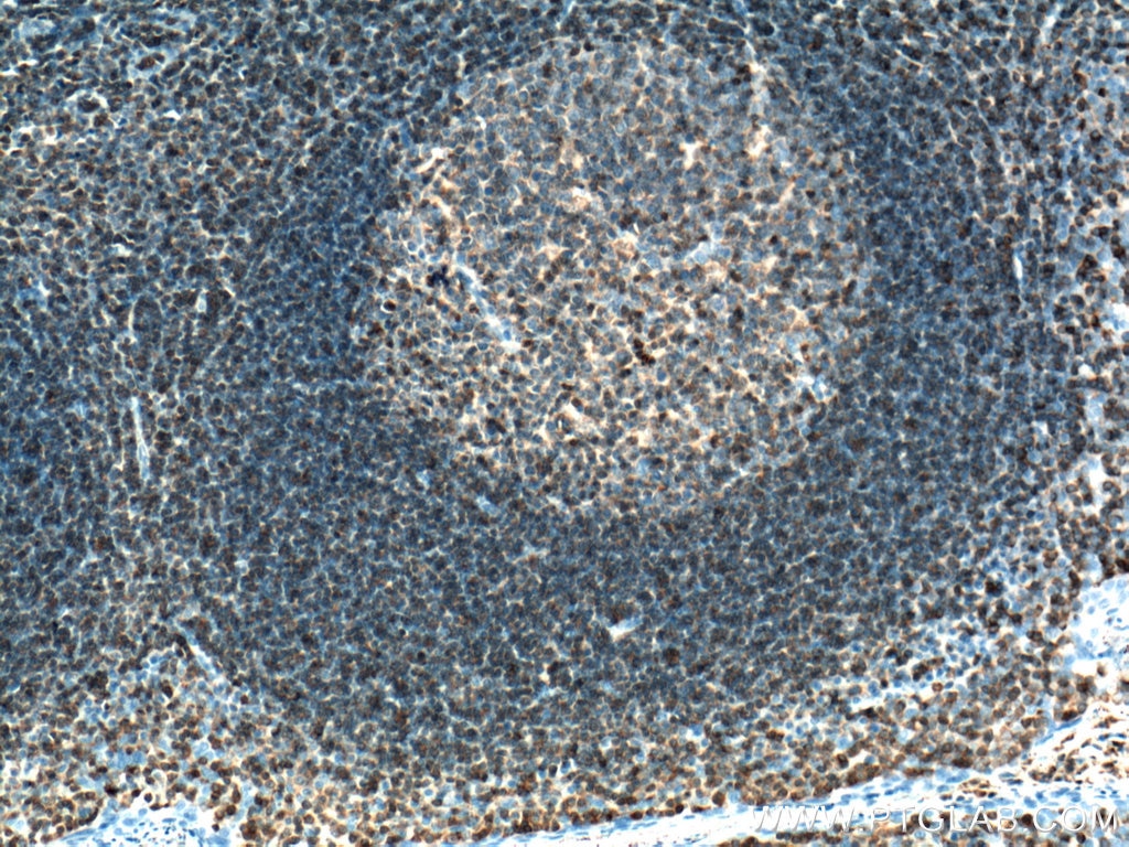 Immunohistochemistry (IHC) staining of human tonsillitis tissue using ARHGDIB Monoclonal antibody (66054-1-Ig)