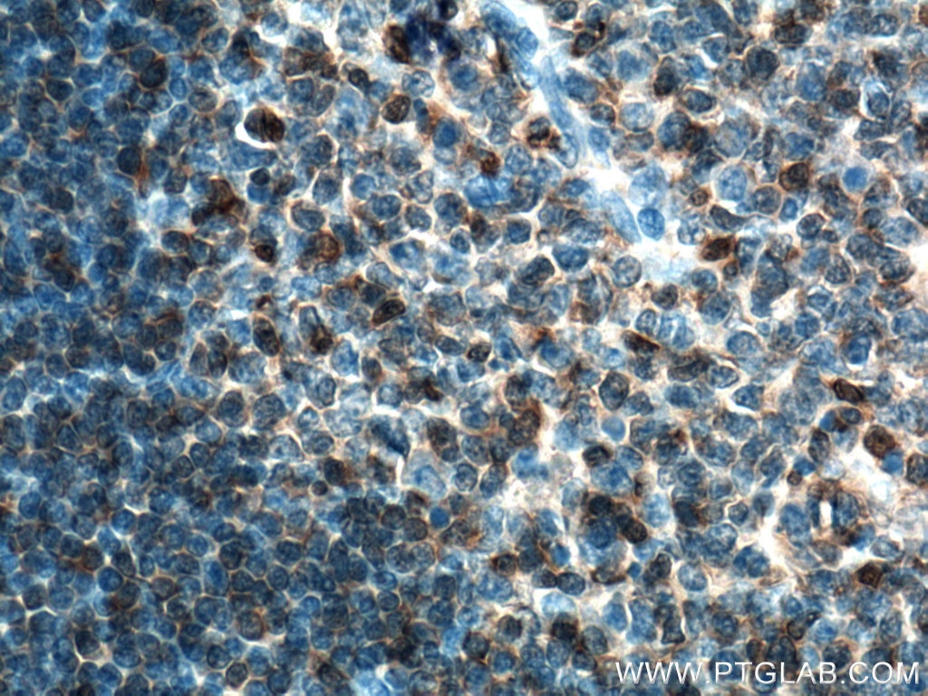 Immunohistochemistry (IHC) staining of human tonsillitis tissue using ARHGDIB Monoclonal antibody (66054-1-Ig)