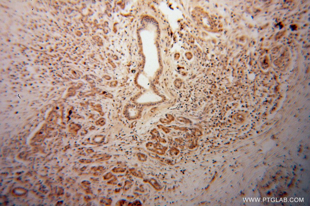 Immunohistochemistry (IHC) staining of human pancreas cancer tissue using ARHGDIG Polyclonal antibody (14282-1-AP)
