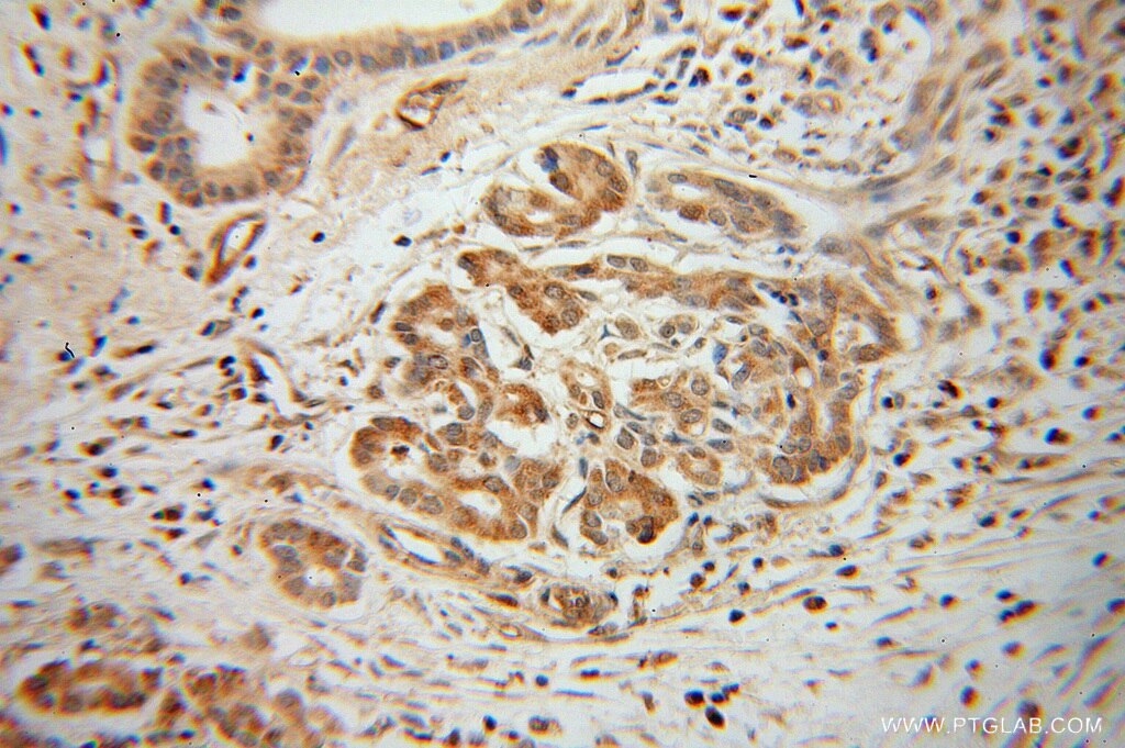 Immunohistochemistry (IHC) staining of human pancreas cancer tissue using ARHGDIG Polyclonal antibody (14282-1-AP)