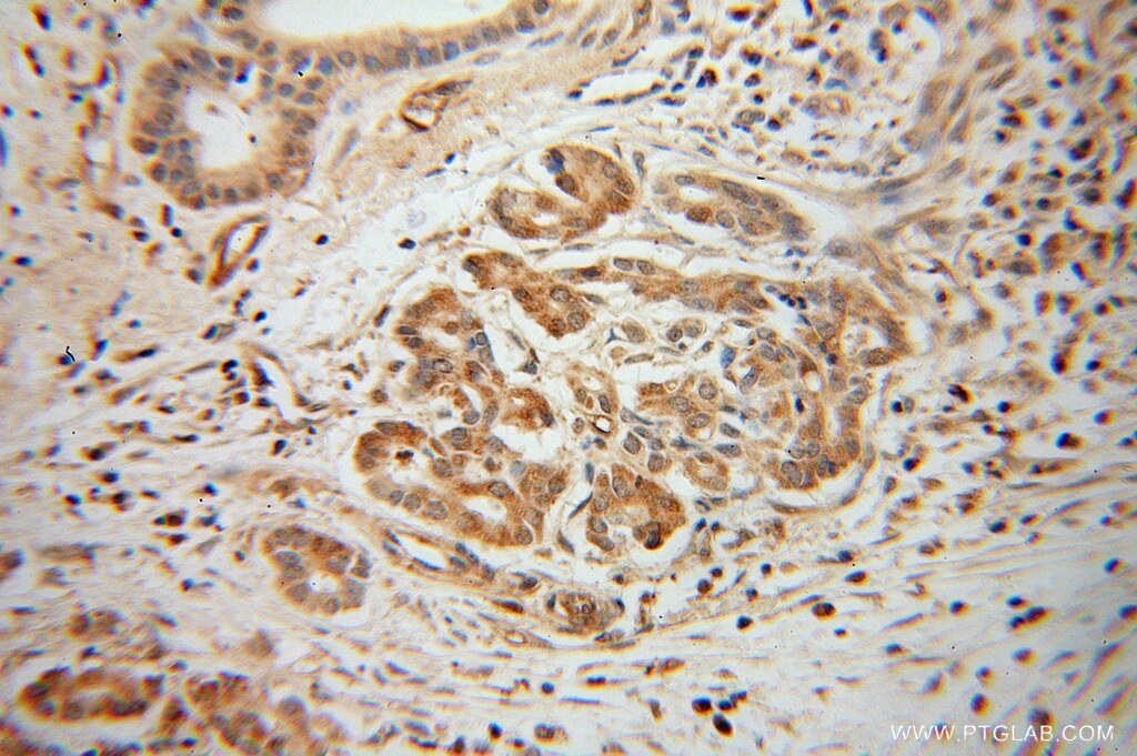 IHC staining of human pancreas cancer using 14282-1-AP