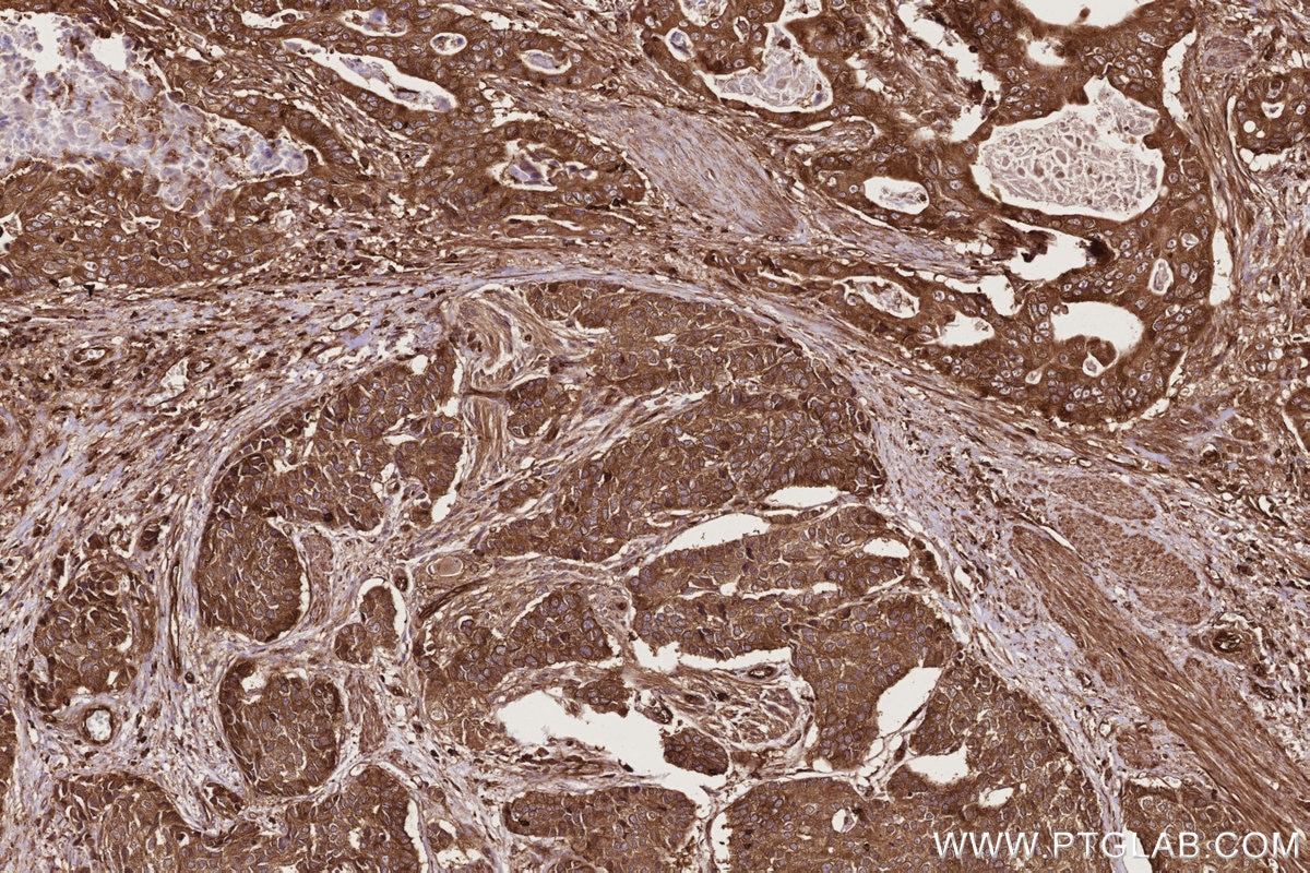 Immunohistochemistry (IHC) staining of human stomach cancer tissue using ARHGEF1 Polyclonal antibody (11363-1-AP)